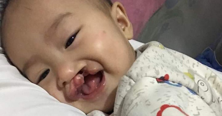 Gia đình dân tộc Tày khó khăn cần 20 triệu đồng phẫu thuật cho con