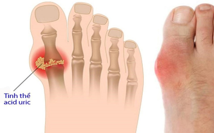 Người bị bệnh gút kiêng ăn gì và nên ăn gì để kiểm soát cơn đau?