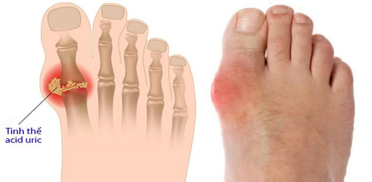 Người bị bệnh gút kiêng ăn gì và nên ăn gì để kiểm soát cơn đau? - Ảnh 1.
