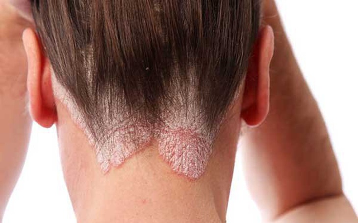 Bệnh vảy nến: Nguyên nhân, dấu hiệu và biện pháp dự phòng