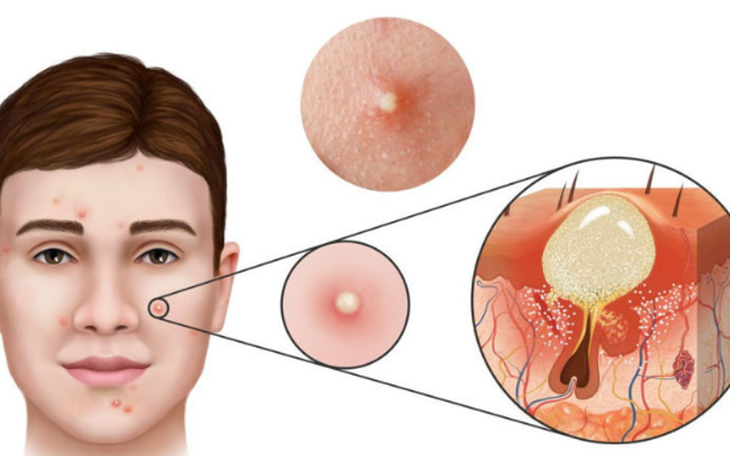 Mụn trứng cá: Nguyên nhân và cách kiểm soát mụn hiệu quả