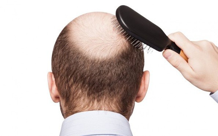 Thuốc nào trị chứng rụng tóc, hói đầu?