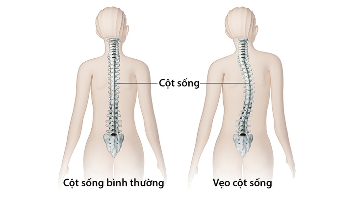 Nhận biết triệu chứng, nguyên nhân và điều trị cong vẹo cột sống ở trẻ - Ảnh 2.