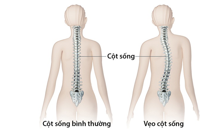 Cong vẹo cột sống ở trẻ - Nhận biết, nguyên nhân và điều trị