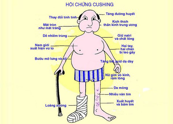Hội chứng Cushing - nguyên nhân do đâu, điều trị thế nào? - Ảnh 2.