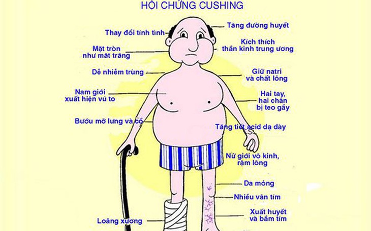 Hội chứng Cushing - Nguyên nhân do đâu, điều trị thế nào?