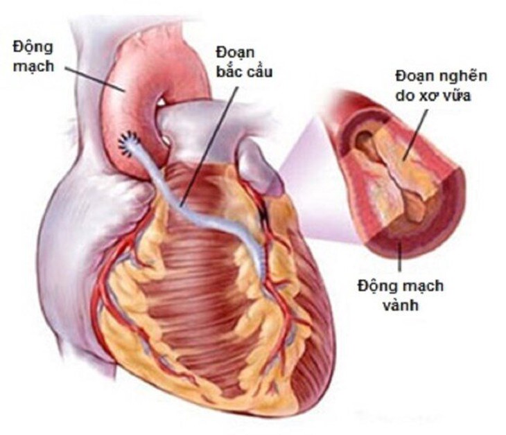 Phẫu thuật bắc cầu động mạch vành: Giải pháp tối ưu giảm thiểu nguy cơ nhồi máu cơ tim - Ảnh 2. Phẫu thuật bắc cầu động mạch vành: Giải pháp tối ưu giảm thiểu nguy cơ nhồi máu cơ tim - Ảnh 2.
