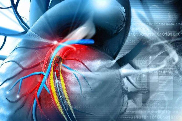 Phẫu thuật bắc cầu động mạch vành: Giải pháp tối ưu giảm thiểu nguy cơ nhồi máu cơ tim - Ảnh 4. Phẫu thuật bắc cầu động mạch vành: Giải pháp tối ưu giảm thiểu nguy cơ nhồi máu cơ tim - Ảnh 4.