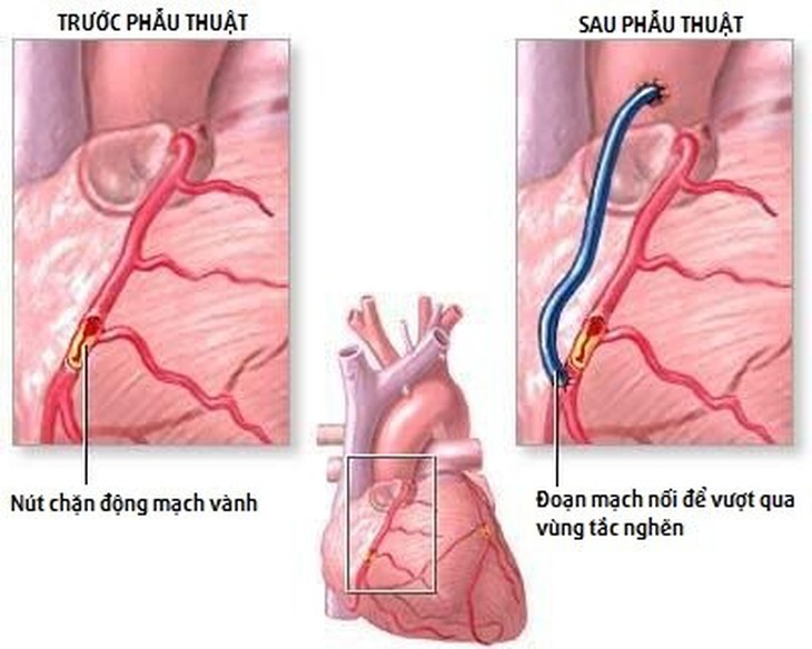 Phẫu thuật bắc cầu động mạch vành: Giải pháp tối ưu giảm thiểu nguy cơ nhồi máu cơ tim - Ảnh 3. Phẫu thuật bắc cầu động mạch vành: Giải pháp tối ưu giảm thiểu nguy cơ nhồi máu cơ tim - Ảnh 3.