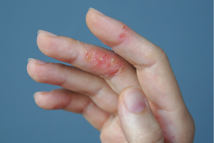 Ủy ban Châu Âu phê duyệt thuốc mới điều trị viêm da dị ứng - Ảnh 1.