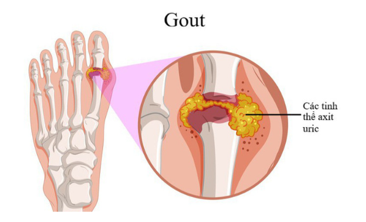 Người mắc bệnh gút nên kiêng gì? - Ảnh 2. Người mắc bệnh gút nên kiêng gì? - Ảnh 2.