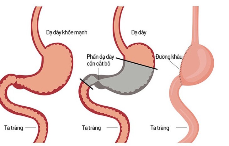 Sau phẫu thuật cắt dạ dày nên ăn uống thế nào để hồi phục nhanh? - Ảnh 1.