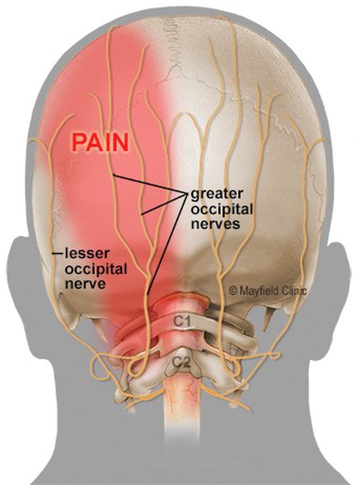 Tiêm phong bế thần kinh chẩm – cách giảm đau đối với người đau đầu, đau thần kinh mãn tính - Ảnh 2. Tiêm phong bế thần kinh chẩm – cách giảm đau đối với người đau đầu, đau thần kinh mãn tính - Ảnh 2.