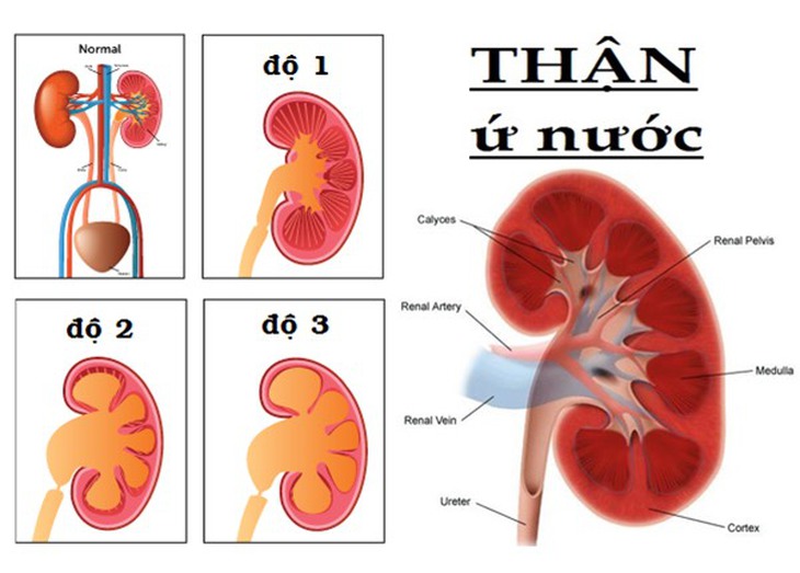 Đau mỏi hông lưng, tiểu buốt, tiểu rắt… cảnh giác với thận ứ nước - Ảnh 1.