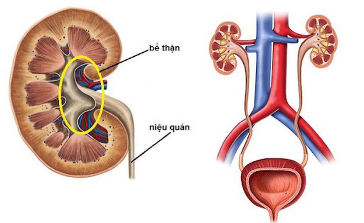 Đau mỏi hông lưng, tiểu buốt, tiểu rắt… cảnh giác với thận ứ nước - Ảnh 3.