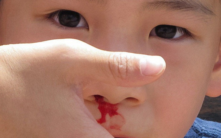 Chảy máu cam ở trẻ gia tăng khi thời tiết hanh khô và cách xử trí