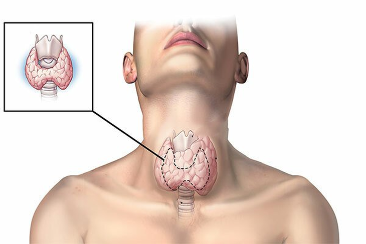 Dấu hiệu của bướu cổ là gì? Khi nào cần đi khám và điều trị? - Ảnh 1. Dấu hiệu của bướu cổ là gì? Khi nào cần đi khám và điều trị? - Ảnh 1.