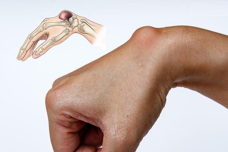 Viêm màng bao hoạt dịch khớp: Tiến triển biến chứng và cách phòng bệnh - Ảnh 4.
