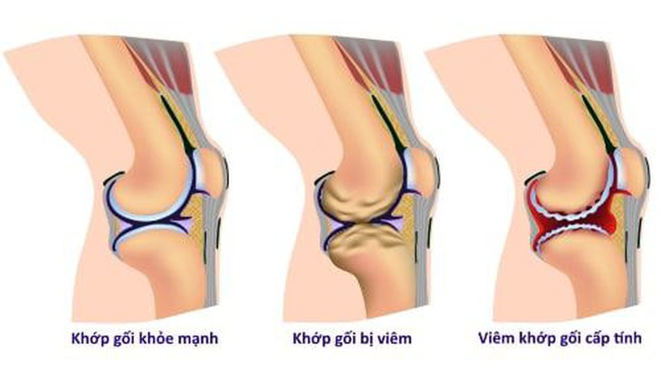 Các liệu pháp hỗ trợ điều trị viêm khớp gối - Ảnh 2.