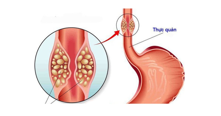 Những vấn đề thường gặp ở người bệnh ung thư thực quản và lưu ý khi chăm sóc - Ảnh 1.