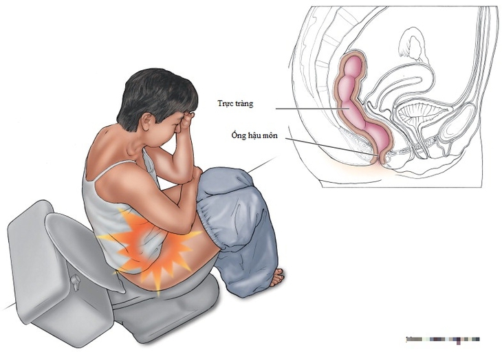 6 nguyên nhân thường gặp gây đau hậu môn và cách khắc phục - Ảnh 4.