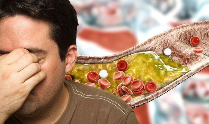 Cholesterol: Thủ phạm gây ra những bệnh lý về tim mạch cần lưu ý - Ảnh 3.