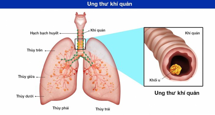 Thở khò khè, ho cảnh giác với ung thư khí quản - Ảnh 2.