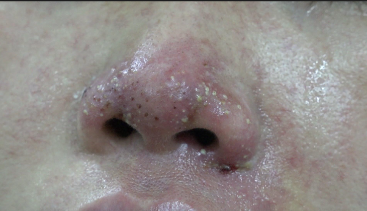 Tiêm filler nâng mũi ở spa, một phụ nữ ở TP.HCM bị biến chứng hoại tử - Ảnh 1.