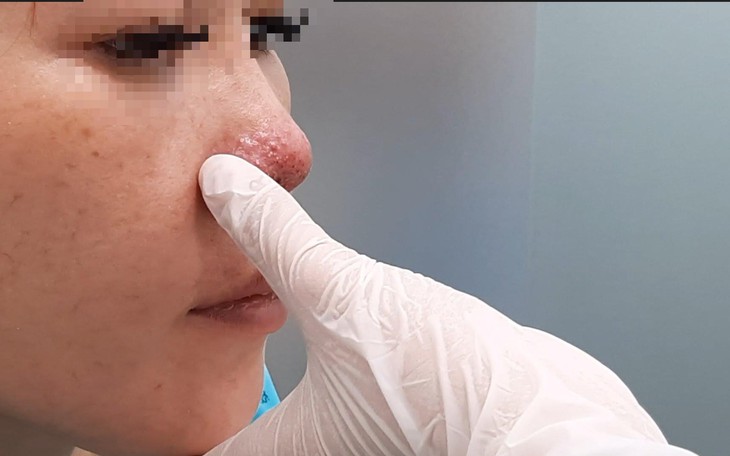 Tiêm filler nâng mũi ở spa, một phụ nữ ở TP.HCM bị biến chứng hoại tử