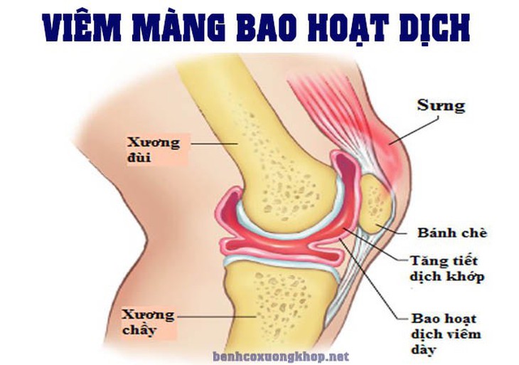 Điểm mặt một số nguyên nhân gây đau khớp gối - Ảnh 3. Điểm mặt một số nguyên nhân gây đau khớp gối - Ảnh 3.