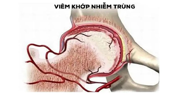 Điểm mặt một số nguyên nhân gây đau khớp gối - Ảnh 6. Điểm mặt một số nguyên nhân gây đau khớp gối - Ảnh 6.
