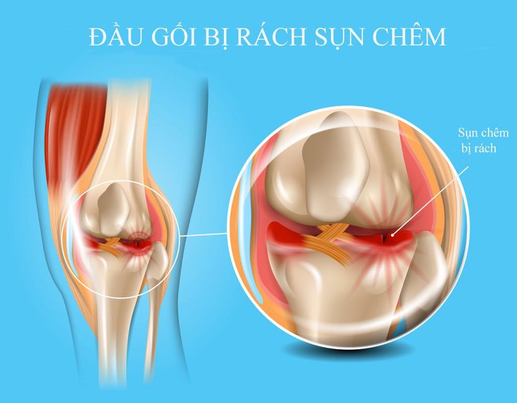 Điểm mặt một số nguyên nhân gây đau khớp gối - Ảnh 7. Điểm mặt một số nguyên nhân gây đau khớp gối - Ảnh 7.
