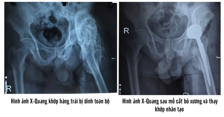 Thay khớp háng nhân tạo để phục hồi biến chứng dính khớp sau mổ sọ não - Ảnh 1. Thay khớp háng nhân tạo để phục hồi biến chứng dính khớp sau mổ sọ não - Ảnh 1.