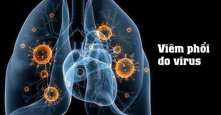 Viêm phổi do virus ở trẻ em: Triệu chứng, điều trị và cách chăm sóc - Ảnh 2.
