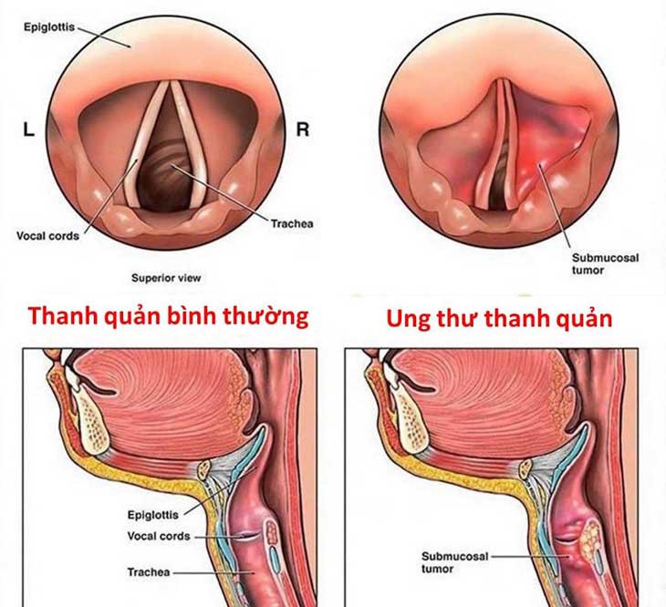 Ung thư thanh quản: Dấu hiệu, nguyên nhân, điều trị và tiên lượng - Ảnh 2. Ung thư thanh quản: Dấu hiệu, nguyên nhân, điều trị và tiên lượng - Ảnh 2.