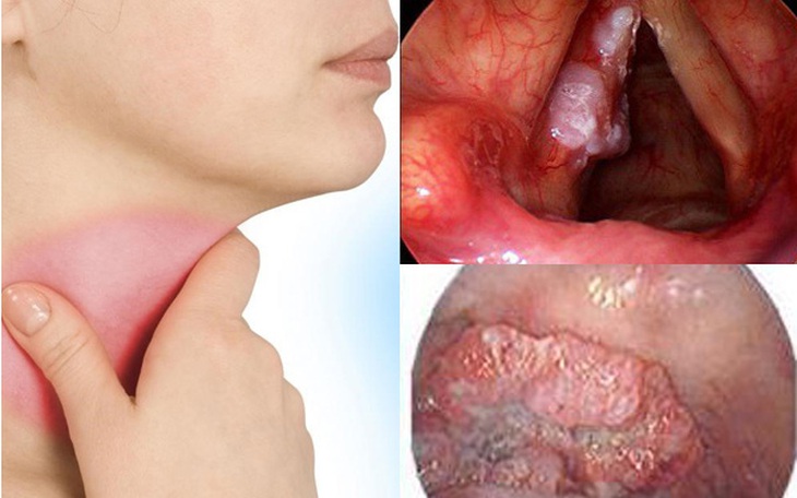 Ung thư thanh quản: Dấu hiệu, nguyên nhân, điều trị và tiên lượng