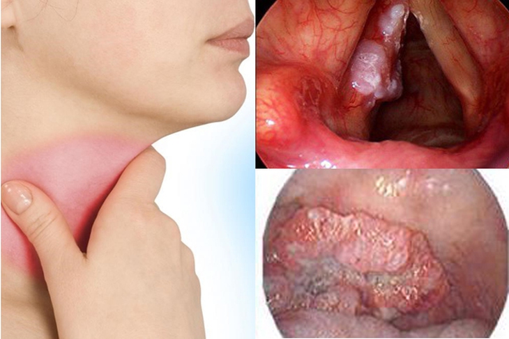 Ung thư thanh quản: Dấu hiệu, nguyên nhân, điều trị và tiên lượng - Ảnh 4. Ung thư thanh quản: Dấu hiệu, nguyên nhân, điều trị và tiên lượng - Ảnh 4.