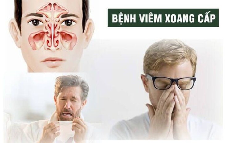 Viêm mũi xoang cấp: Thời tiết lạnh phòng và cách điều trị đúng - Ảnh 2.