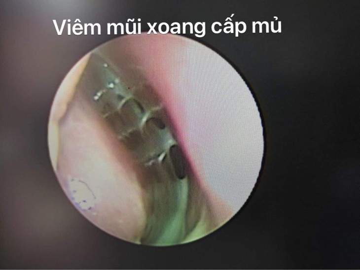 Viêm mũi xoang cấp: Thời tiết lạnh phòng và cách điều trị đúng - Ảnh 5.
