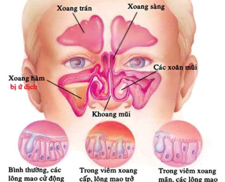 Viêm mũi xoang cấp: Thời tiết lạnh phòng và cách điều trị đúng - Ảnh 1.