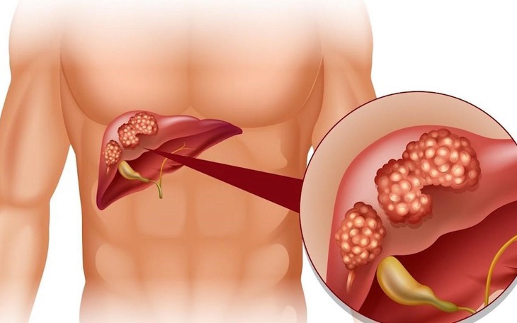 Tổng hợp các cách giúp hỗ trợ thải độc gan an toàn