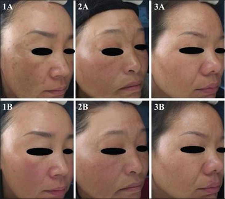 Giải pháp thay thế hydroquinone trong hỗ trợ giảm nám - Ảnh 3.
