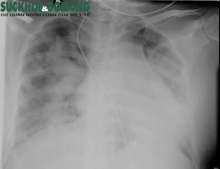 Bão Cykotine bất ngờ ập đến thai phụ mắc COVID-19, bác sĩ vẫn bảo toàn mạng sống cho cả mẹ và con - Ảnh 2.