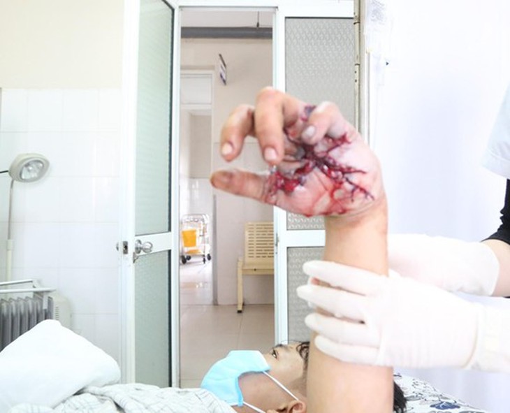 Suýt mất bàn tay do tự chế pháo nổ - Ảnh 2.