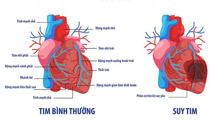 Nhận biết nguyên nhân và đề phòng biến chứng của suy tim - Ảnh 2.
