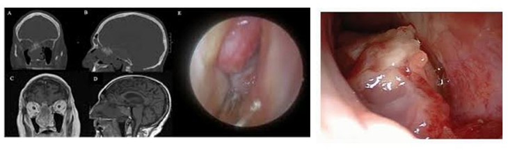 U ác tính mũi xoang: Biểu hiện, phân loại và chẩn đoán - Ảnh 2. U ác tính mũi xoang: Biểu hiện, phân loại và chẩn đoán - Ảnh 2.
