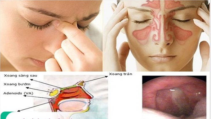 Giảm triệu chứng viêm mũi xoang khi thời tiết cuối năm thay đổi- Ảnh 1. Giảm triệu chứng viêm mũi xoang khi thời tiết cuối năm thay đổi- Ảnh 1.