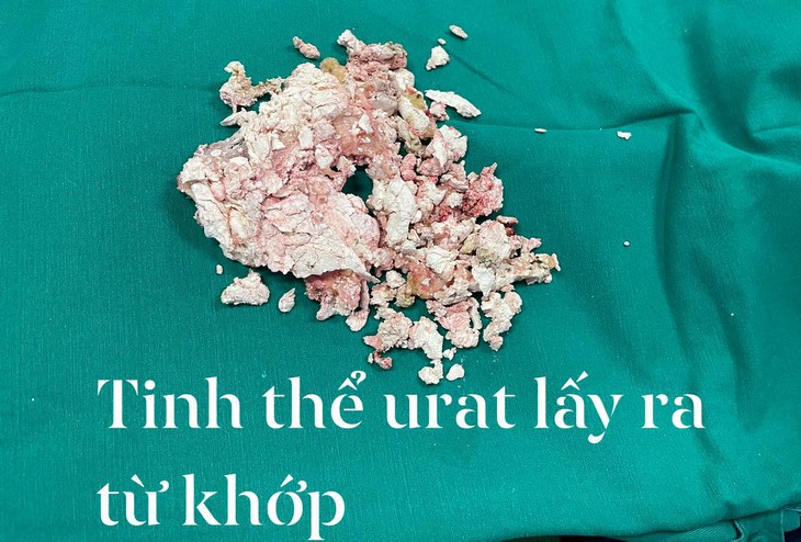 Nếu không muốn 38 tuổi đã phải phẫu thuật thay 2 khớp gối vì bị gout, hãy nghe lời khuyên của bác sĩ - Ảnh 3.