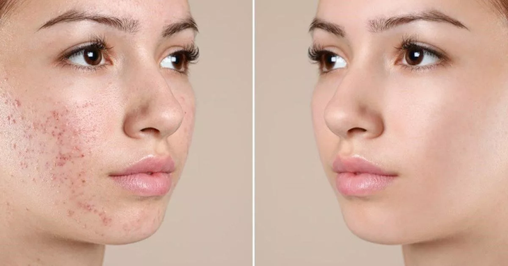 Cách trị mụn bằng công nghệ cao - Ảnh 1.