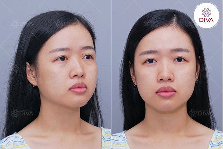 Foxy Eyes – phương pháp giải cứu đôi mắt cụp rũ buồn - Ảnh 1.